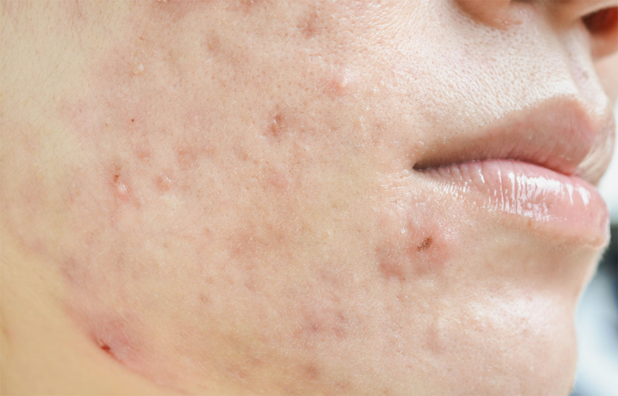 Female adult with acne on the right side of her face.